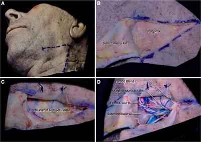 Endoscopy-assisted high cervical anterolateral retropharyngeal approach to clivus: a cadaveric study
